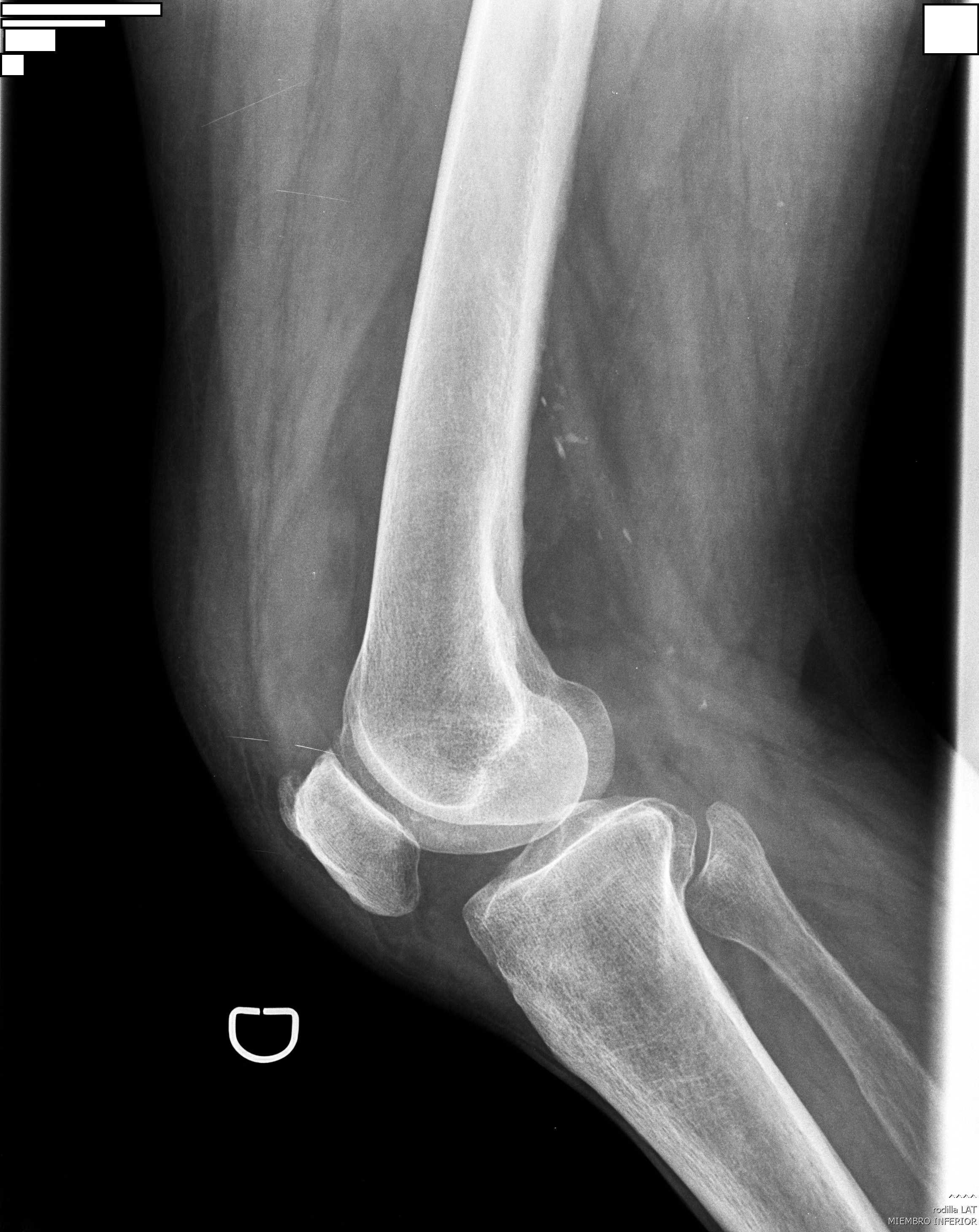 Posicionamiento Lateral de Rodilla